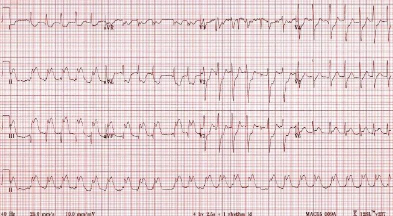 ECG for Geelong SAQ 016 question 5