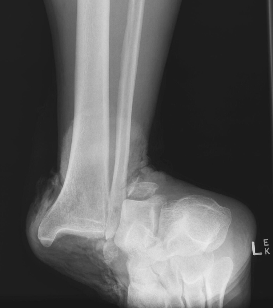 Left ankle x-ray for Geelong SAQ 017 question 2