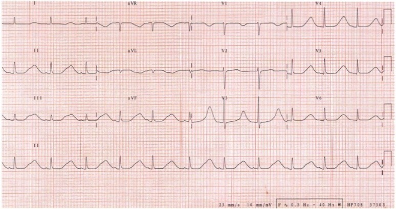 ECG for Geelong SAQ 017 question 5