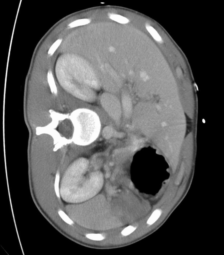 CT abdomen showing spleen for Geelong SAQ 017 question 6