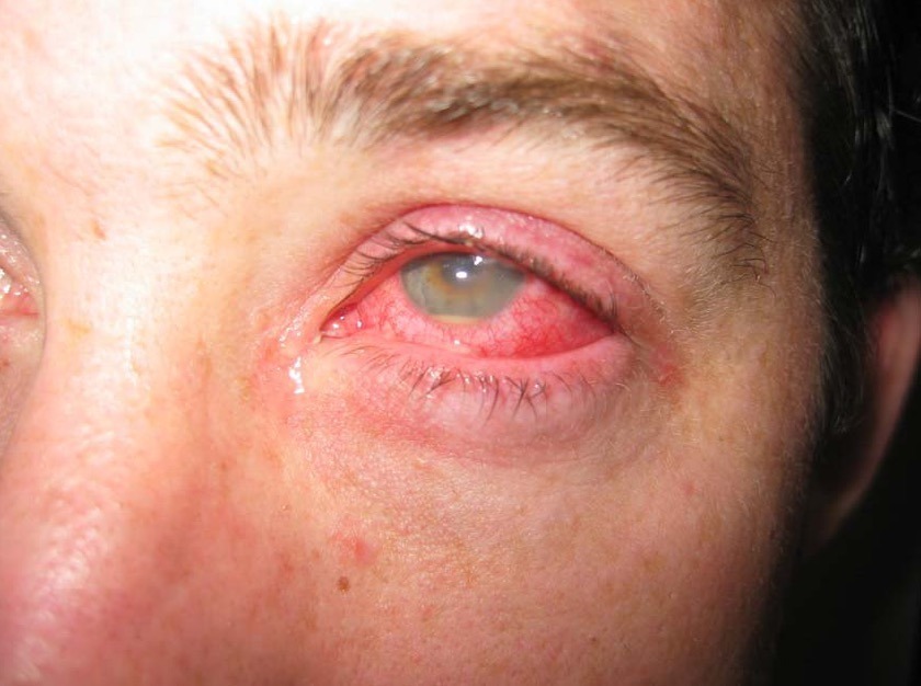Photograph of hypopyon for Geelong SAQ 017 question 8