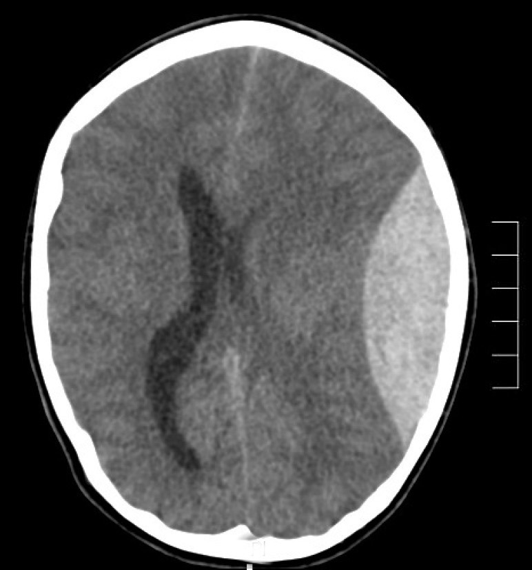 CT brain for Geelong SAQ 017 question 9