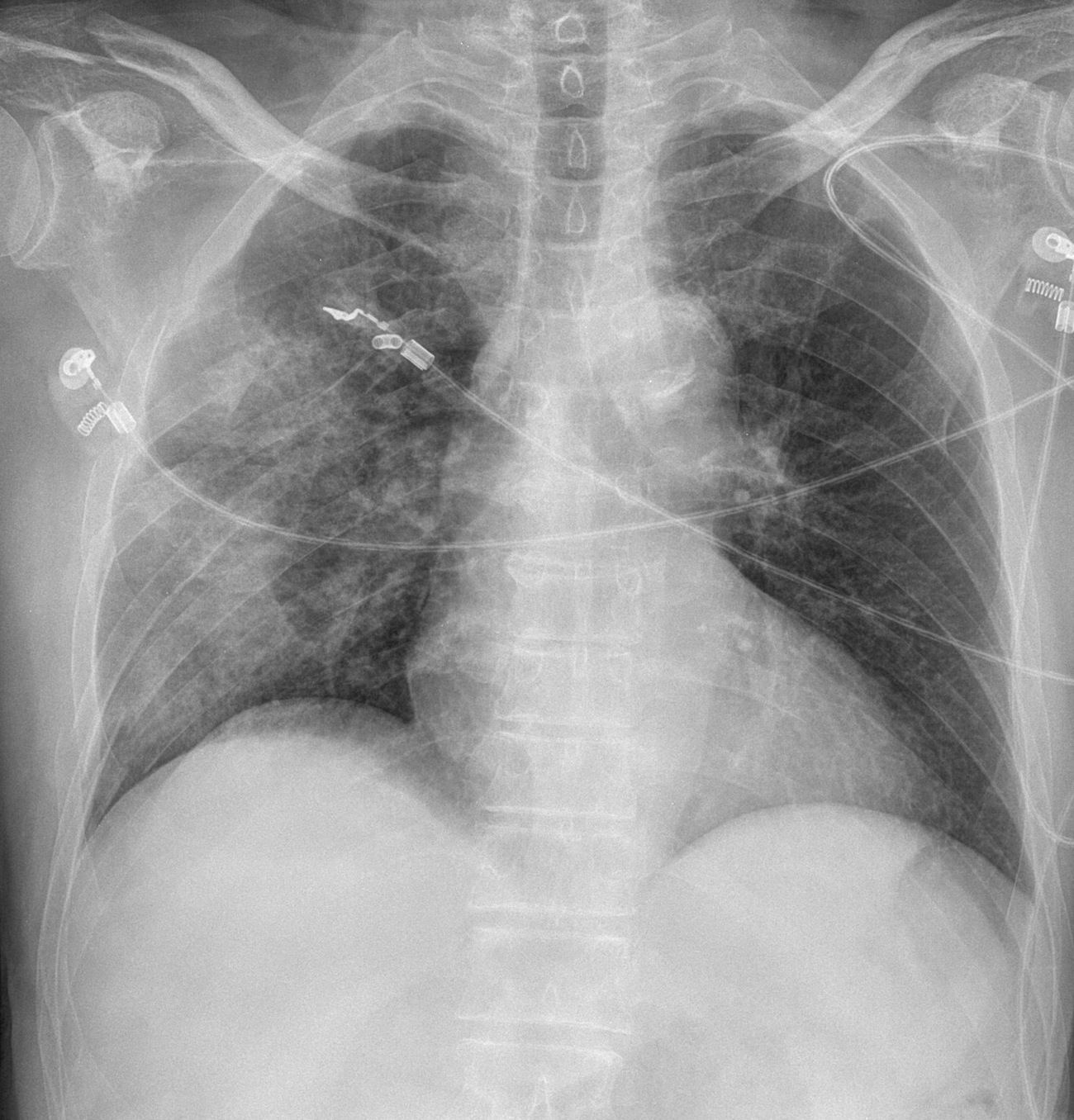 Chest x-ray for Geelong SAQ 018 question 1