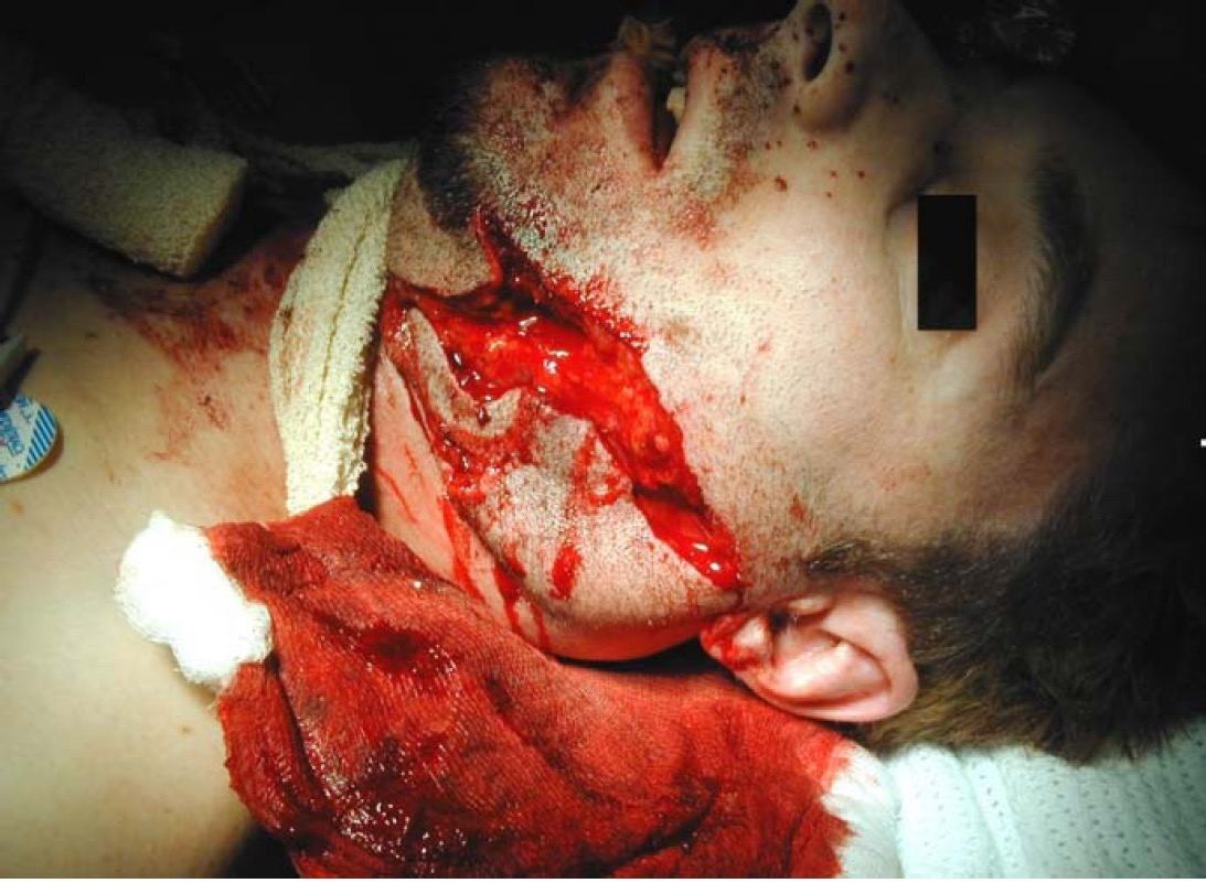 Penetrating neck injury for Geelong SAQ 018 question 4