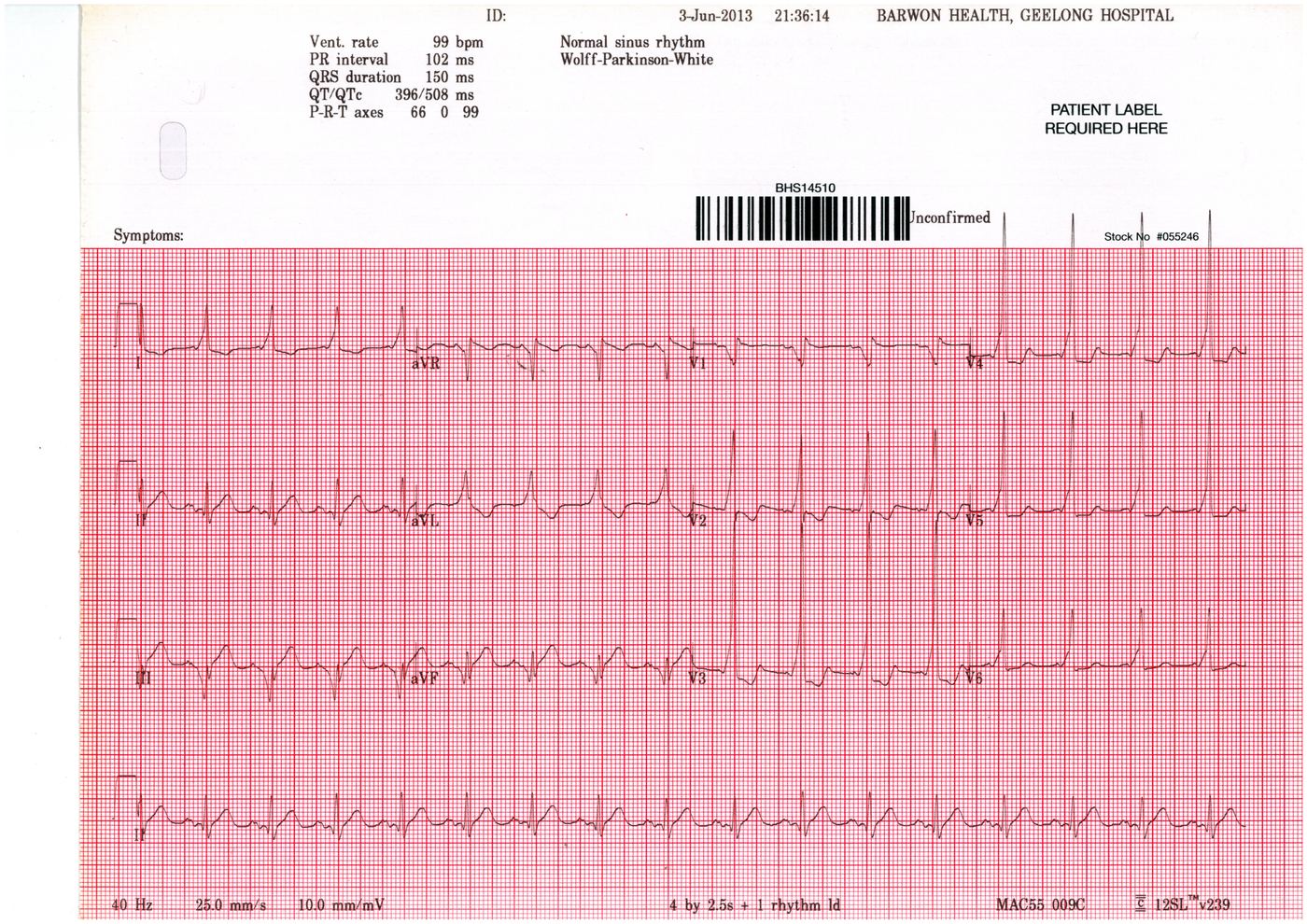 ECG showing pre-excitation for Geelong SAQ 018 question 5