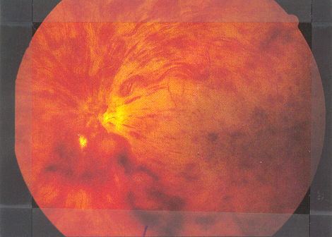Fundus photograph for Geelong SAQ 018 question 7