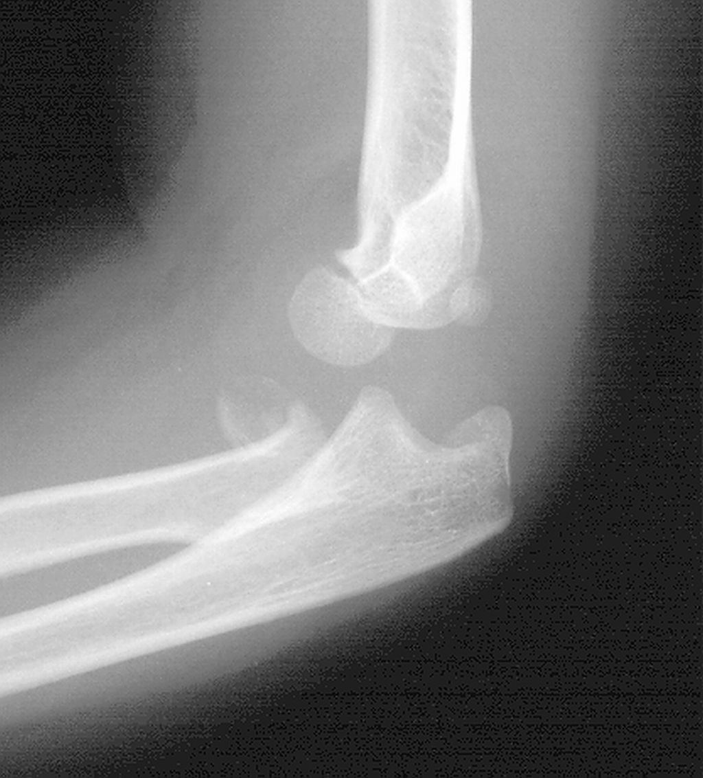 Elbow x-ray for Geelong SAQ 019 question 1