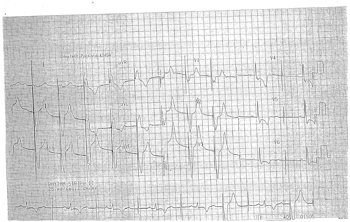 Pacemaker ECG for Geelong SAQ 019 question 5
