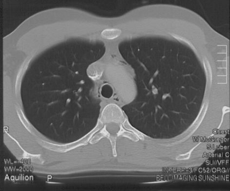 CT chest slice 3 for Geelong SAQ 019 question 6