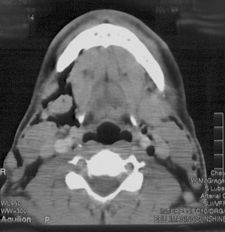 CT neck slice 1 for Geelong SAQ 019 question 6