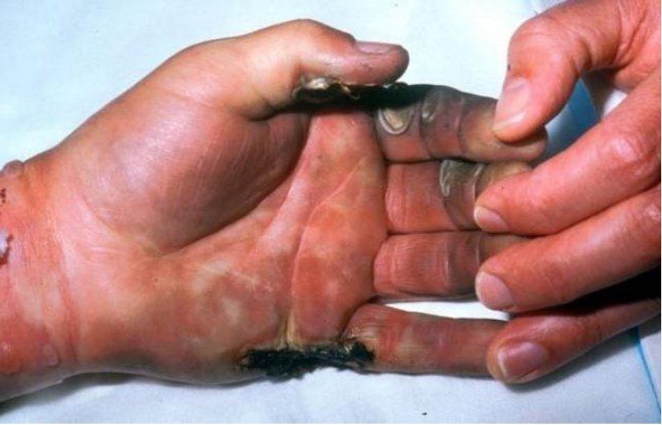 Electrical burn photograph for Geelong SAQ 019 question 9