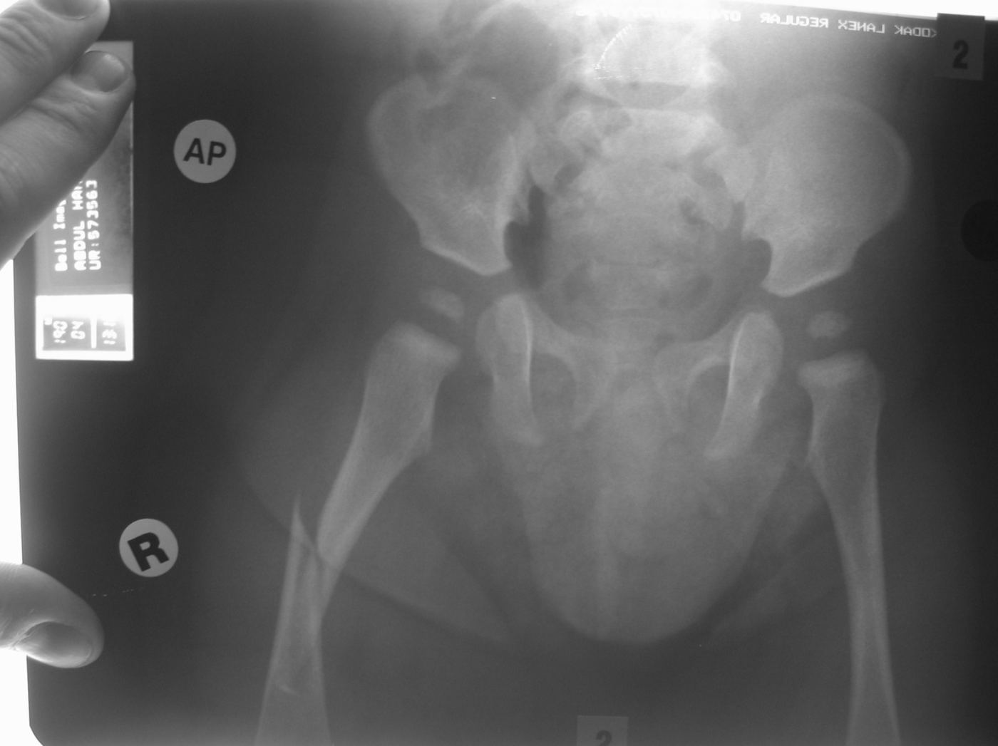 Femur x-ray for Geelong SAQ 020 question 2
