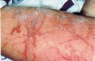 Jellyfish sting photograph for Geelong SAQ 020 question 3