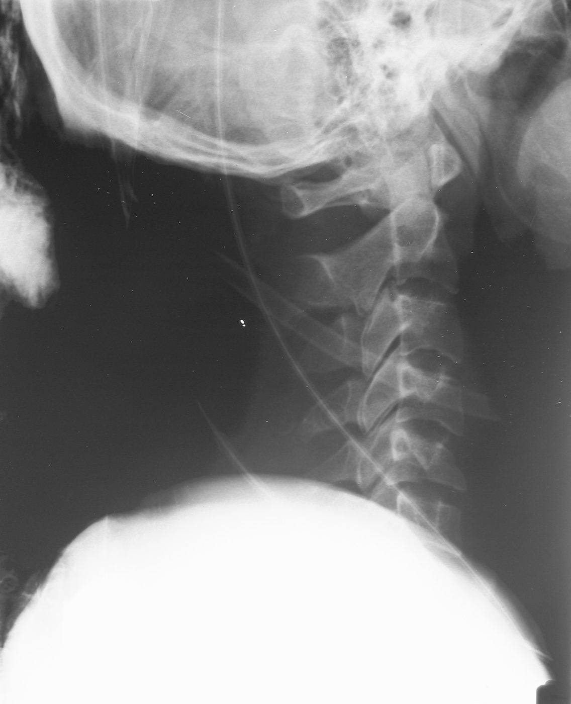 Cervical spine x-ray for Geelong SAQ 021 question 2