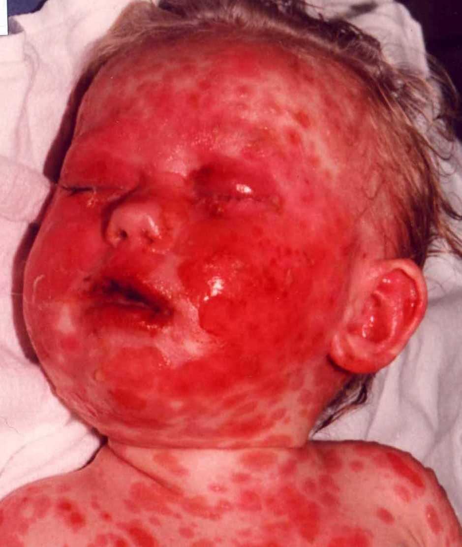 Clinical photograph of toxic epidermal necrolysis for Geelong SAQ 021 question 3