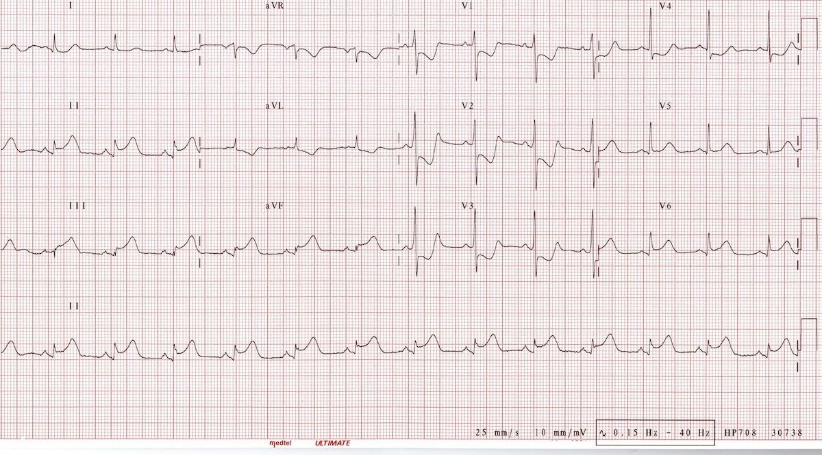 ECG for Geelong SAQ 022 question 5