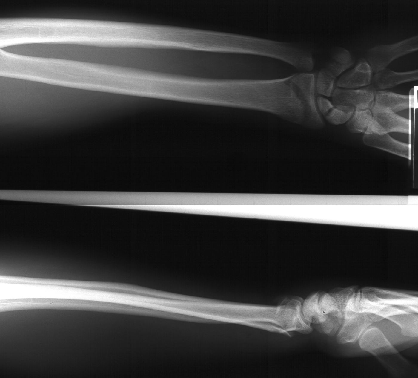 Left wrist x-rays for Geelong SAQ 023 question 1