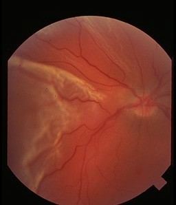 Fundus photograph for Geelong SAQ 023 question 3