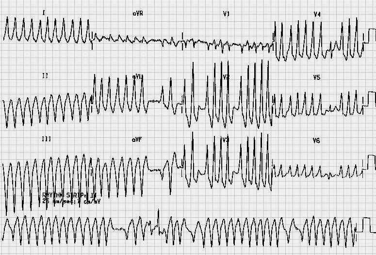 ECG for Geelong SAQ 023 question 5