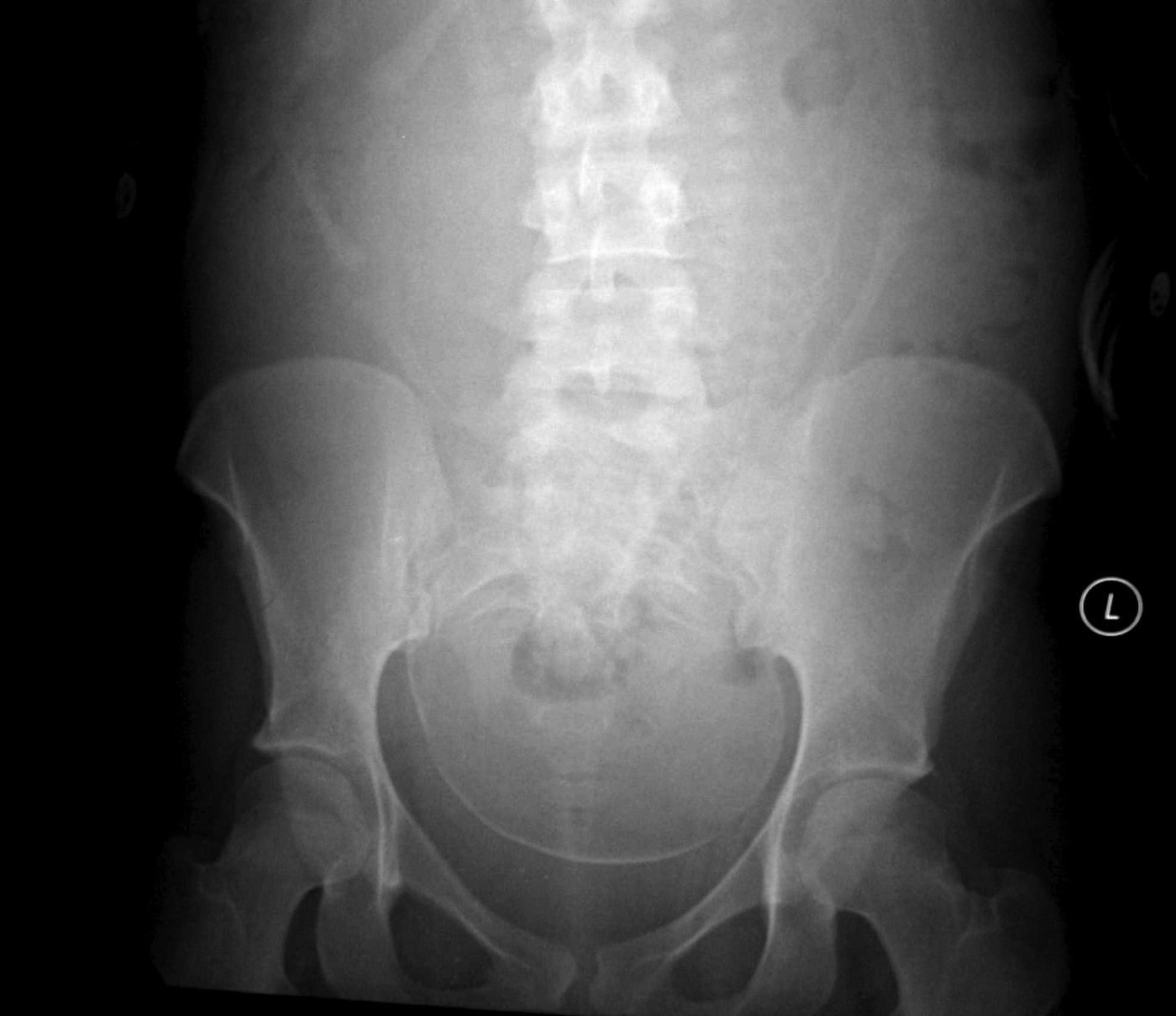 Pelvis x-ray for Geelong SAQ 023 question 6