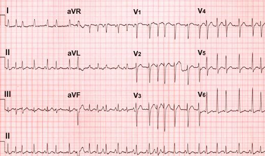 ECG for Geelong SAQ 024 question 5