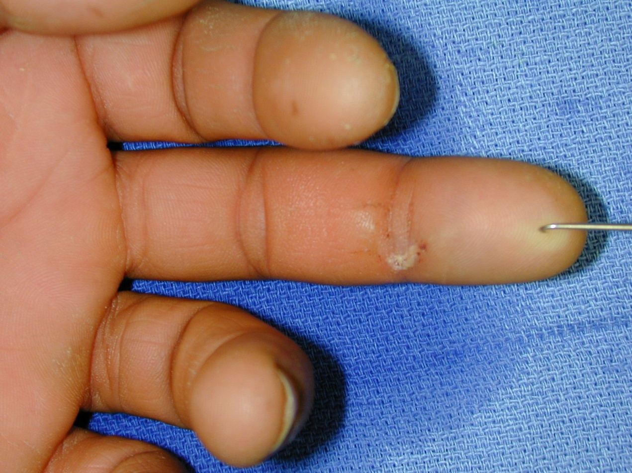 High-pressure finger injection injury photograph 1