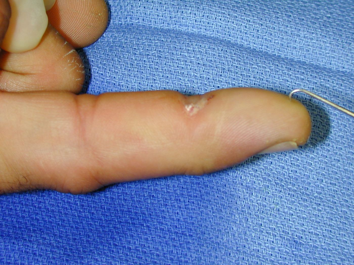 High-pressure finger injection injury photograph 2