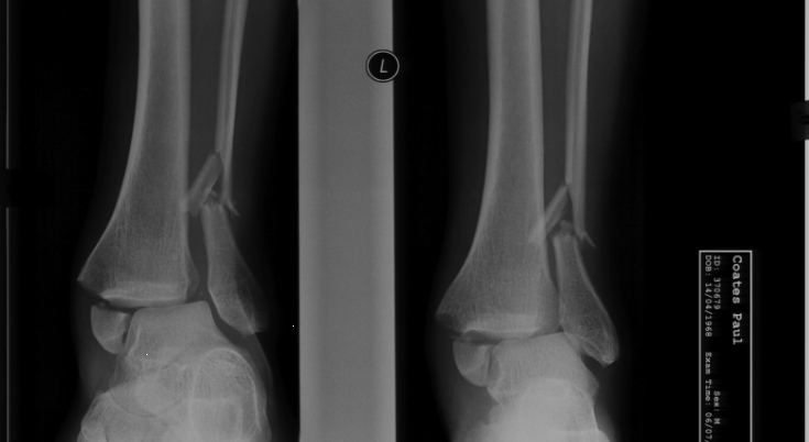 Ankle x-rays 1 and 2 for Geelong SAQ 025 question 8