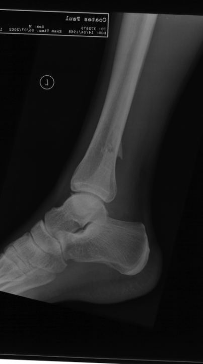 Ankle x-ray 3 for Geelong SAQ 025 question 8
