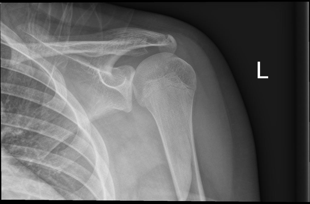 Shoulder x-ray 1 for Geelong SAQ 026 question 4