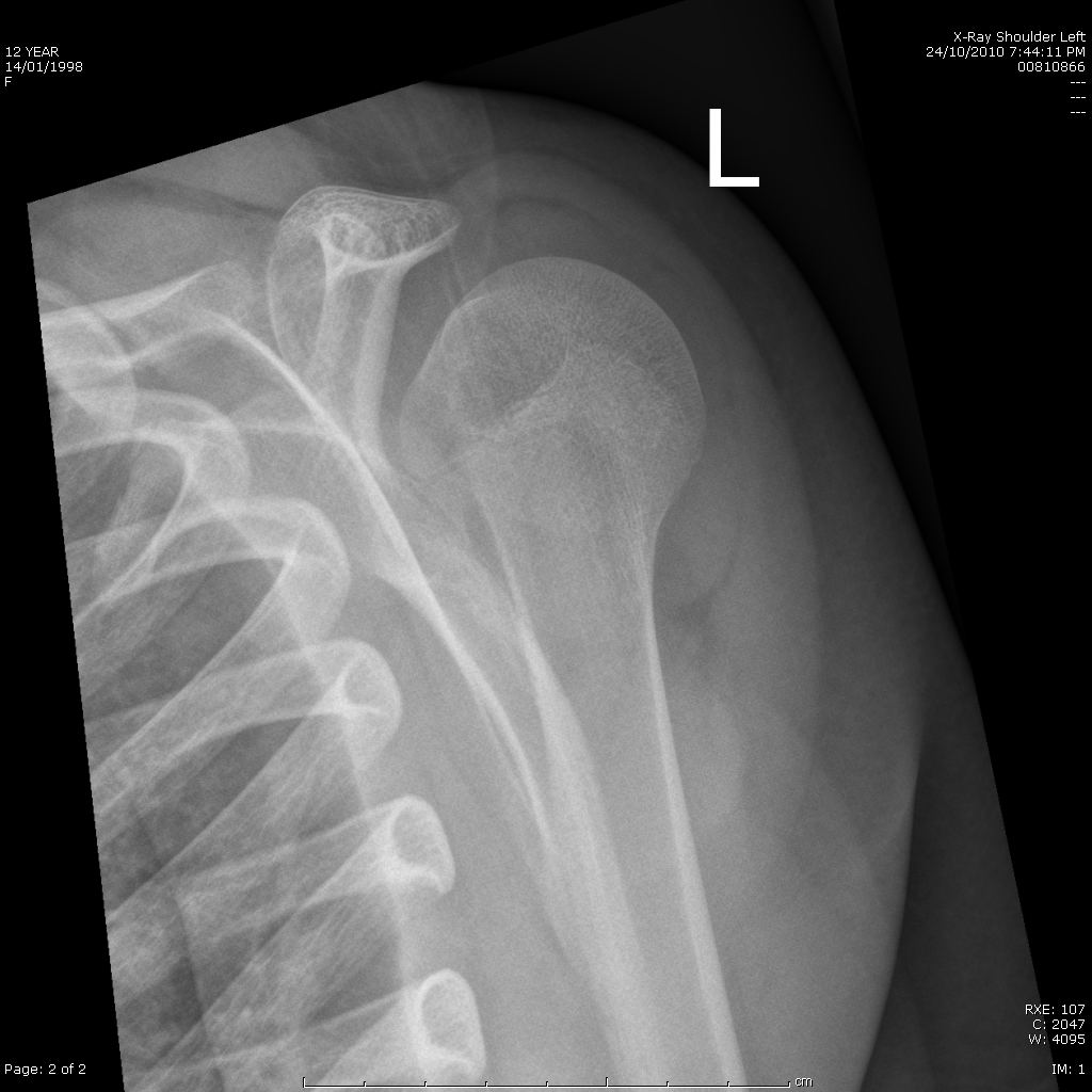 Shoulder x-ray 2 for Geelong SAQ 026 question 4
