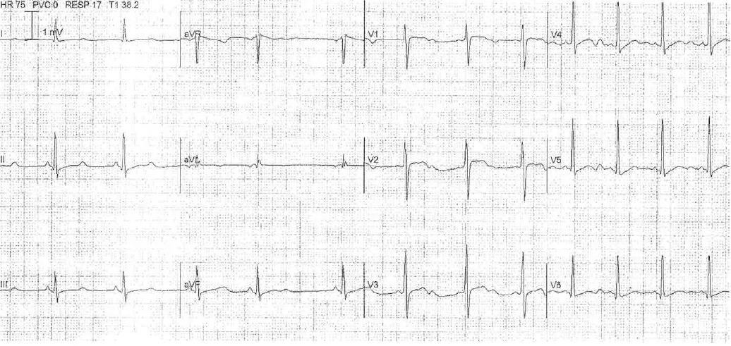 12-lead ECG for Geelong SAQ 026 question 5
