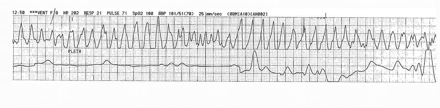 Rhythm strip for Geelong SAQ 026 question 5