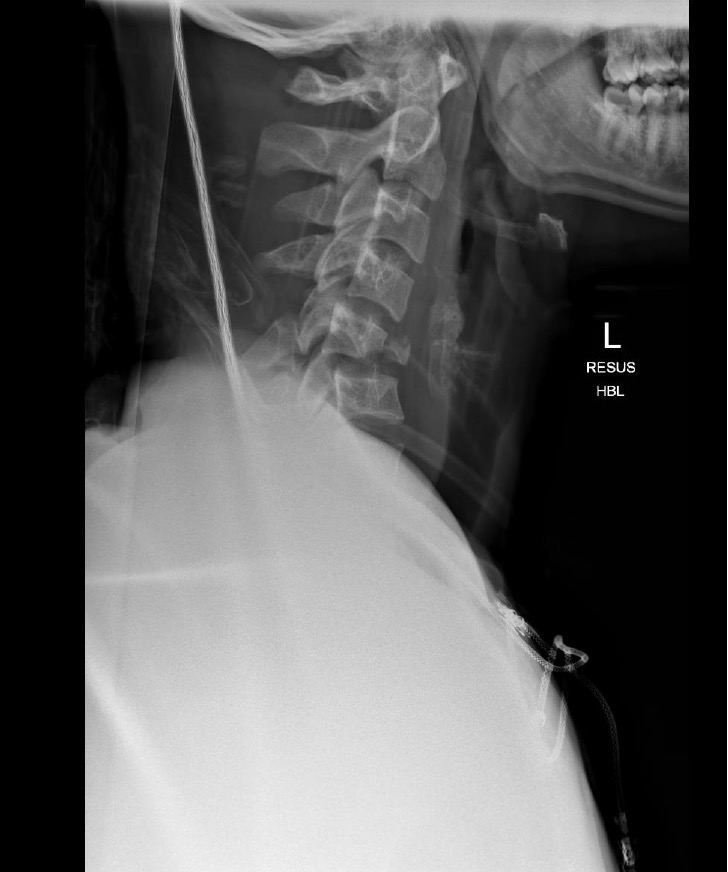 Lateral cervical-spine x-ray for Geelong SAQ 027 question 3