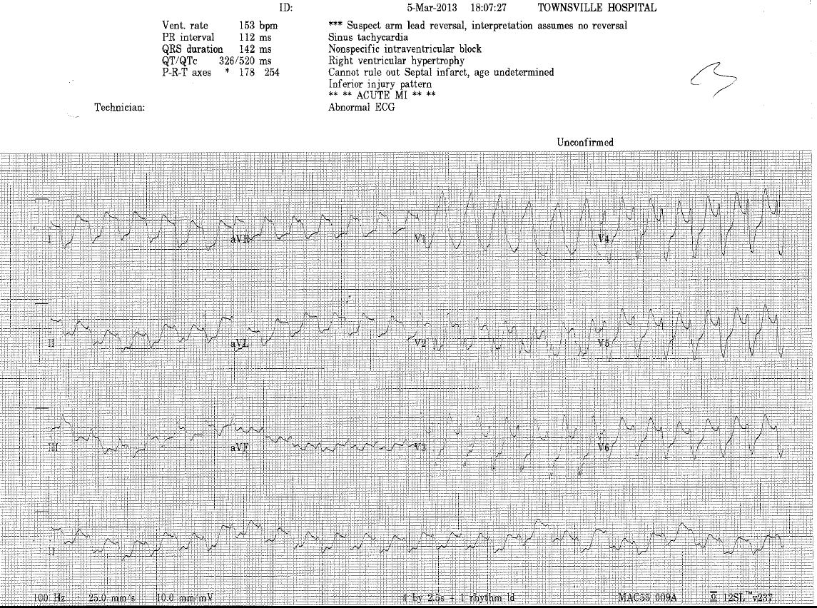 12-lead ECG for Geelong SAQ 027 question 9