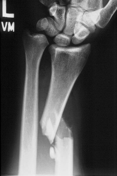 AP left forearm x-ray for Geelong SAQ 028 question 3
