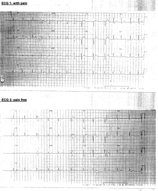 Serial pain and pain-free ECGs for Geelong SAQ 028 question 5