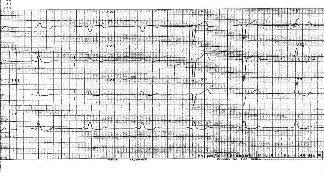 Current pain ECG for Geelong SAQ 029 question 5