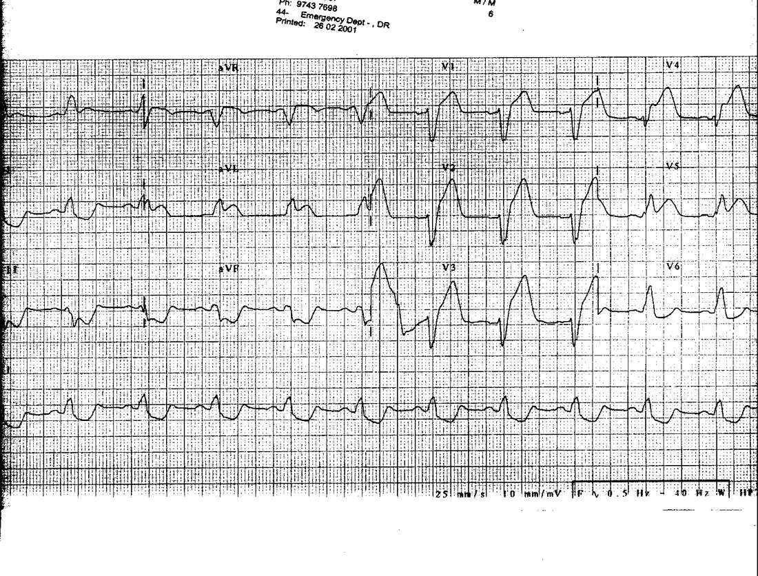 Previous resting ECG for Geelong SAQ 029 question 5