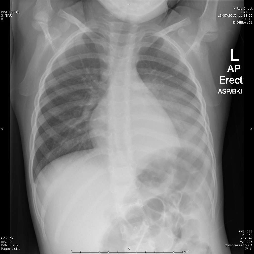 Chest x-ray for Geelong SAQ 029 question 6