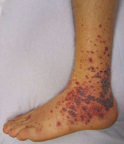 Lower-limb rash for Geelong SAQ 030 question 3