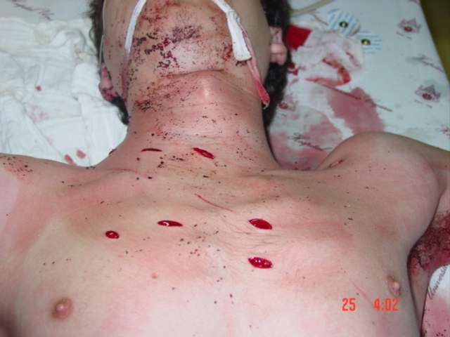 Penetrating chest injuries for Geelong SAQ 030 question 7