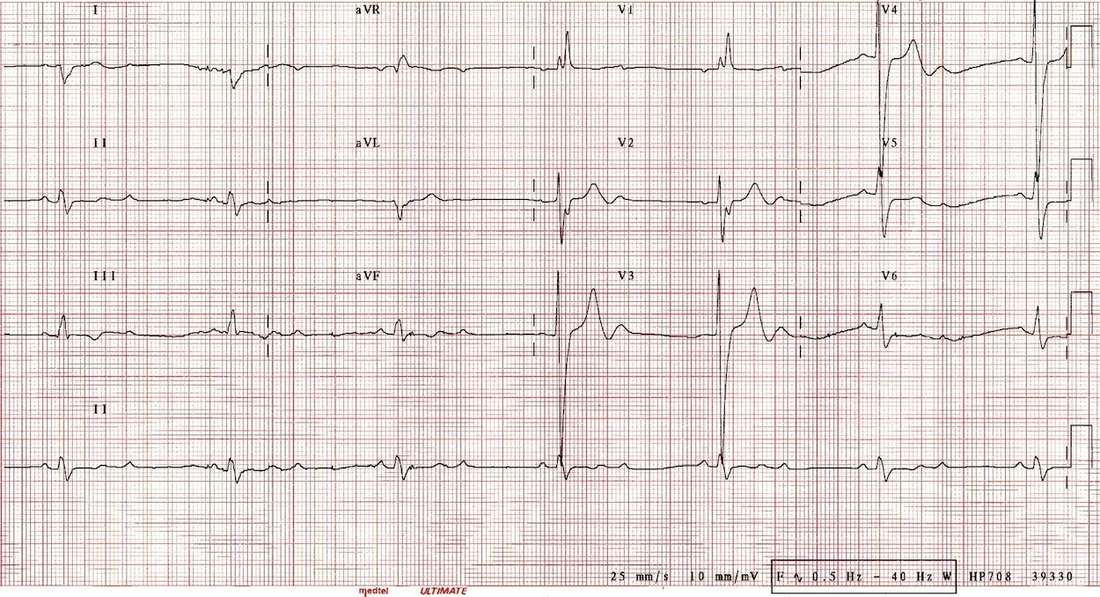 12-lead ECG for Geelong SAQ 030 question 9