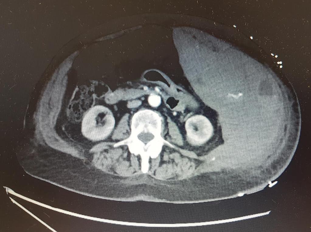 Axial CT image showing a large left abdominal wall haematoma.