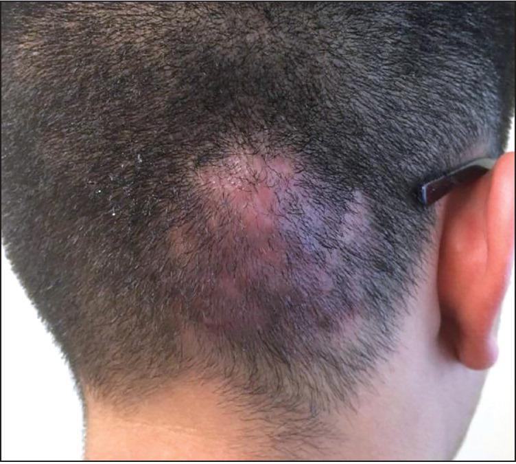 Photo of an erythematous scalp swelling with local alopecia.