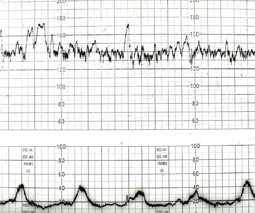 Cardiotocograph trace with fetal heart rate and uterine activity.