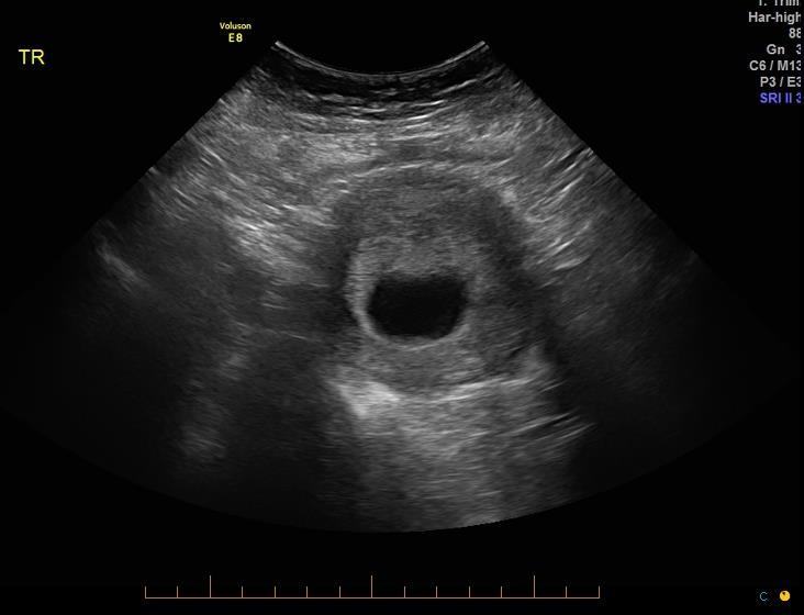 Transvaginal ultrasound image showing an intrauterine gestational sac.