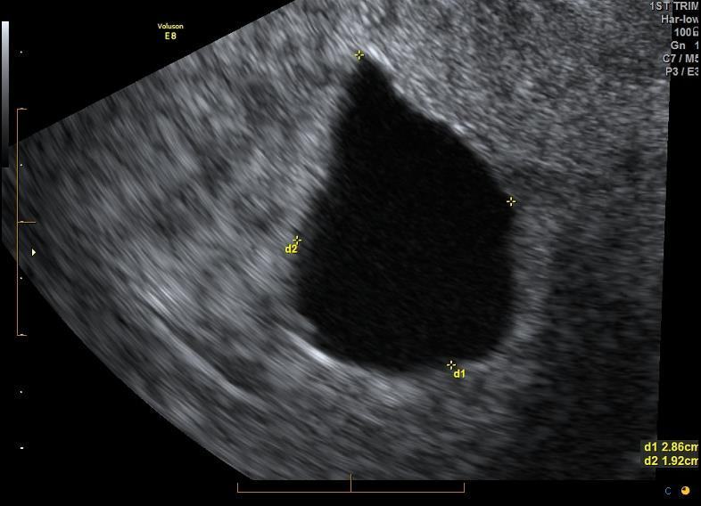 Transvaginal ultrasound image measuring an intrauterine gestational sac.