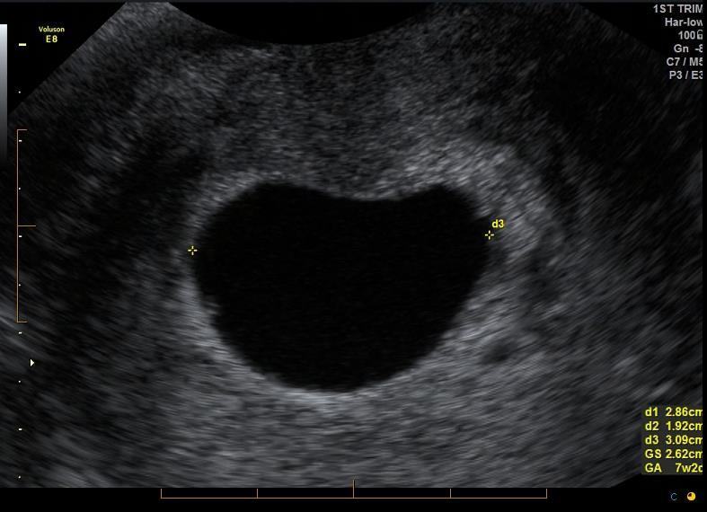 Transvaginal ultrasound image measuring an intrauterine gestational sac.