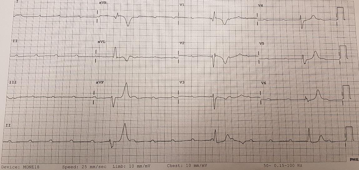 Twelve-lead ECG showing severe bradycardia with complete heart block and broad escape complexes.